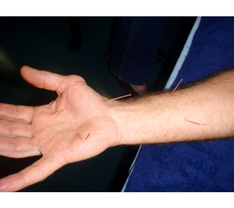 Body And Mind - Mudgeeraba, QLD. Dry Needling Wrist