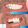 Tampa Dental Implants gallery