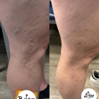 Vein Treatment Center