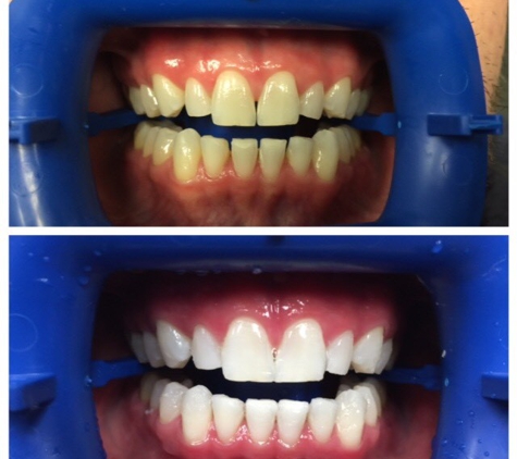 Roach Family Dentistry - Nashville, TN. Before & After