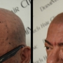 DermiMatch Hair Clinic - SMP (scalp micropigmentation)